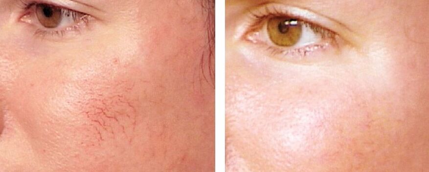Rimozione di Rosacea
