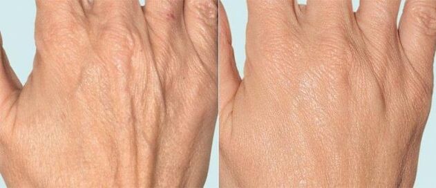 Pelle delle mani prima e dopo la terapia frazionata