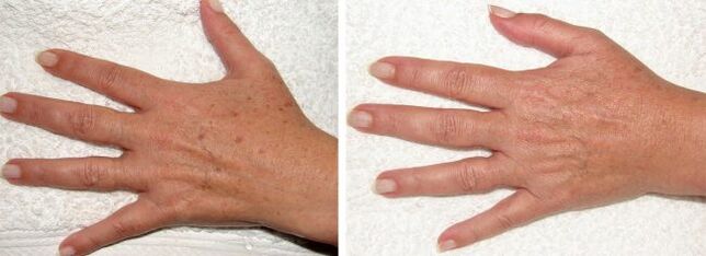 Risultato della rimozione delle macchie di pigmento sulle mani